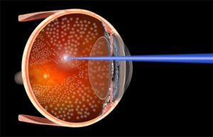 Laseroterapia siatkówki