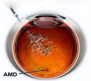 Leczenie anty-VEGF w zwyrodnieniu plamki związanym z wiekiem (AMD)