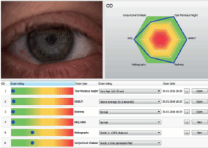 Nowoczesne badania komputerowe w zespole suchego oka, zespół suchego oka
