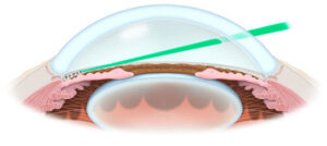 Trabekuloplastyka laserowa (GLT) w jaskrze