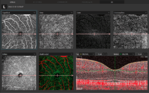 Badanie Angio-OCT nerwu wzrokowego