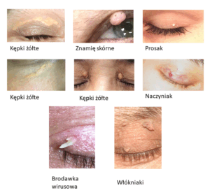 Laserowe usuwanie guzków powiek